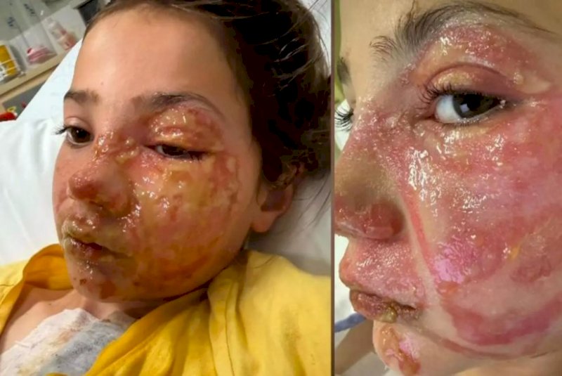 Menina sofre queimaduras no rosto após reproduzir desafio viral de rede social