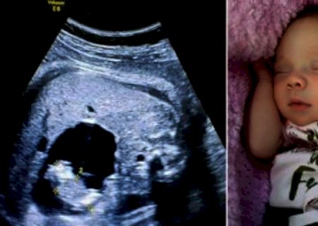 Bebê nasce 'grávida' na Colômbia