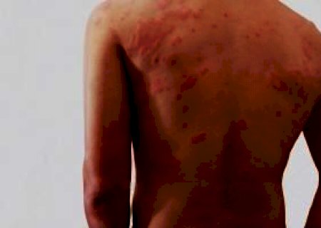 Janeiro Roxo: Brasil é o segundo país com mais casos de hanseníase no mundo;