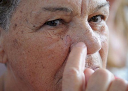 Ministério da Saúde abre consulta sobre diagnóstico do câncer de pele