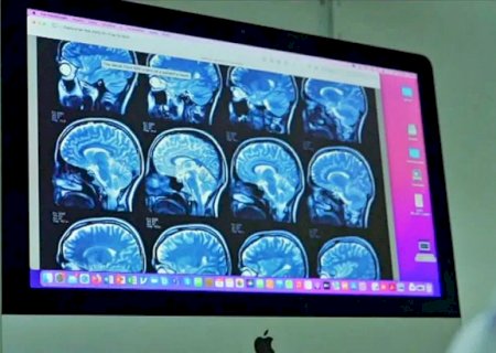 Remédio em estudo parece retardar progressão de Alzheimer