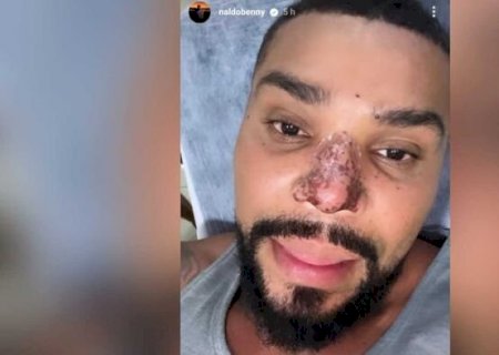 Cantor Naldo tem complicações após rinomodelação, com princípio de necrose no nariz