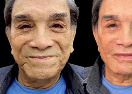 Dedé Santana passa por harmonização facial aos 86 anos e choca: 'carinha de...'