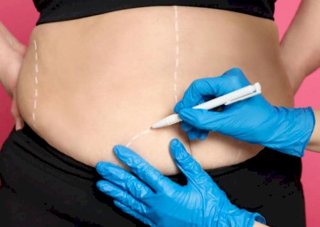 Cirurgia bariátrica: saiba quando o procedimento é uma alternativa