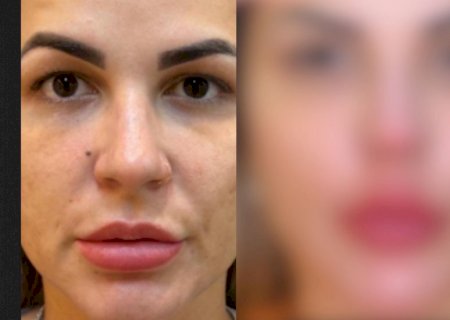 Deolane Bezerra passa por procedimento estético e choca internautas: 'mudou de rosto'