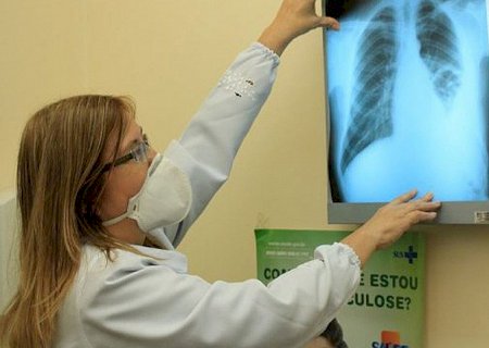 Governo cria comitê para eliminar a tuberculose