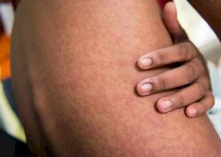Maracaju é a segunda cidade com mais casos de Chikungunya no estado