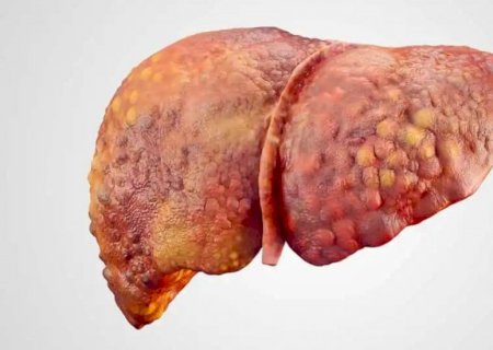 Silenciosa, gordura no fígado afeta até 35% dos adultos e pode ocasionar hepatite e cirrose
