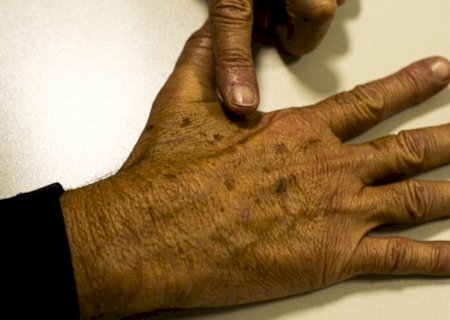 Tecnologia para tratar câncer de pele é aprovado para uso no SUS