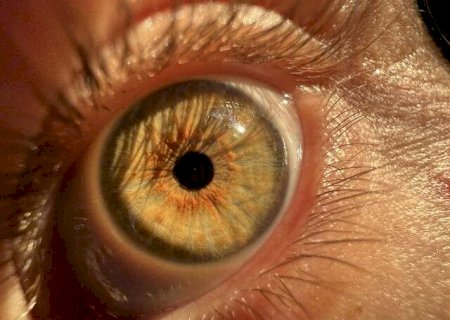 Melanoma uveal: sintomas e tratamento