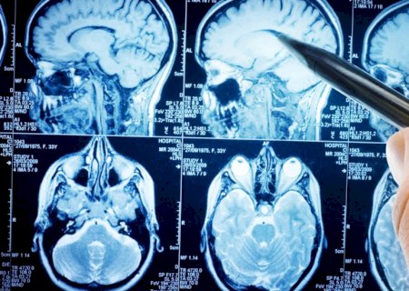 Estudo aponta tratamento promissor no combate a câncer cerebral agressivo e sem cura
