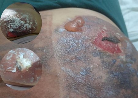 Mulher faz criolipólise na barriga e é internada com queimaduras de 2º grau em Campo Grande