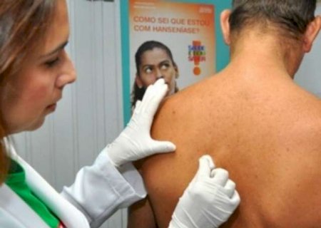 Capital reduz 9% dos casos de hansen&iacute;ase e preven&ccedil;&atilde;o &eacute; arma contra a doen&ccedil;a