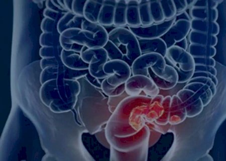 Estudo projeta aumento de 36% em mortes por câncer colorretal até 2040