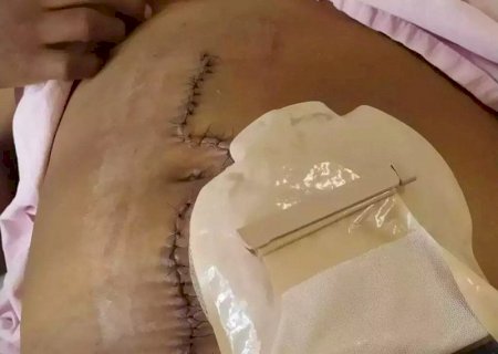 Dourados: Mulher fica quatro meses com gaze esquecida no corpo após cesariana no HU-UFGD