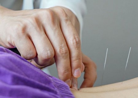 Brasil regulamenta exercício profissional da acupuntura