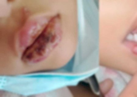 Virose de creche se agrava e deixa criança com lesões graves em UPA (vídeo)