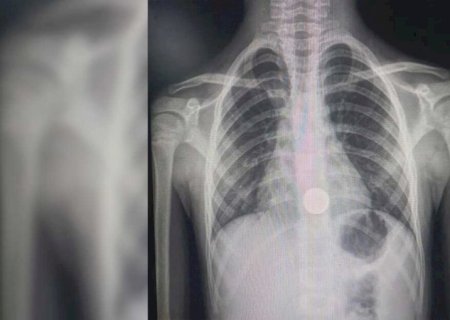 Menino de 7 anos engole moeda e é transferido para Campo Grande para cirurgia