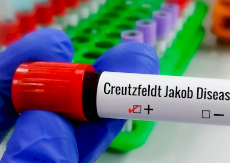 Entenda Doença de Creutzfeldt-Jakob, diagnóstico do piloto Lito Souza