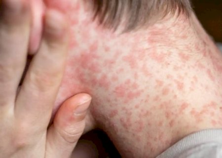 Sarampo: entenda sintomas, riscos e quando se vacinar