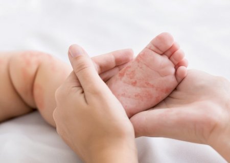 A produção organizada da ignorância recoloca o sarampo no mapa