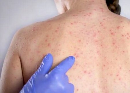 Casos de sarampo sobem para 16 em São Paulo
