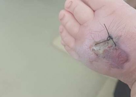 Beb&ecirc; de 1 ano &eacute; internado na Santa Casa ap&oacute;s picada de aranha e necrose no p&eacute;