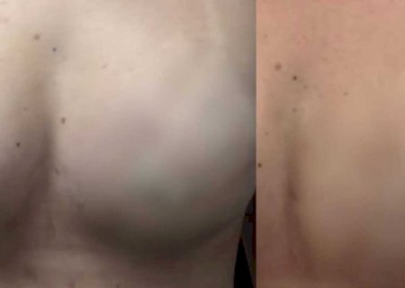 Mulher se especializa em reconstrução de auréolas para ajudar vítimas de câncer de mama em MS